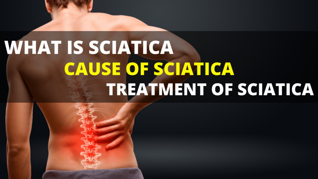 WHAT IS SCIATICA CAUSE OF SCIATICA 